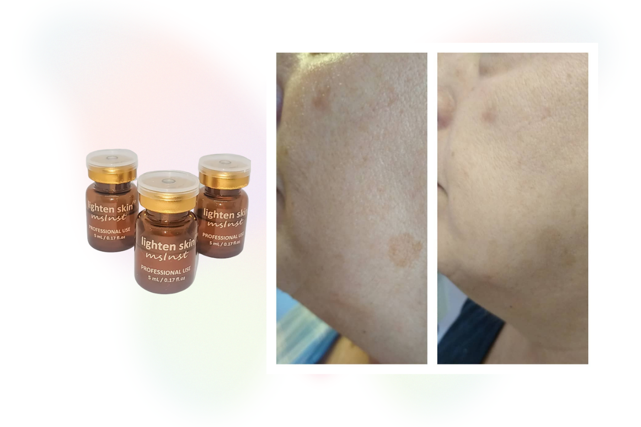 anti spots mesotherapy dark spots melasma chloasma arbutin kojic photoagening depimeting mesoinstitute